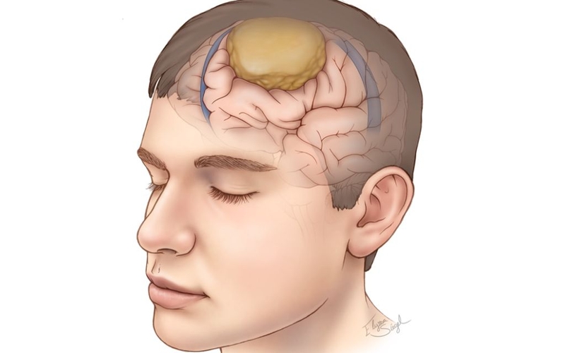 U màng não có nên mổ không? Chi phí và biến chứng sau phẫu thuật 1