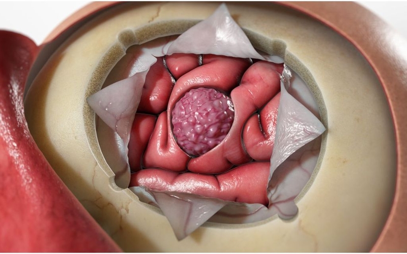 U màng não có nên mổ không? Chi phí và biến chứng sau phẫu thuật 2