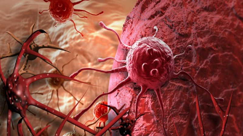 U máu gan là gì? U máu gan có nguy hiểm không? Phương pháp điều trị u máu gan phổ biến mà bạn nên biết 3