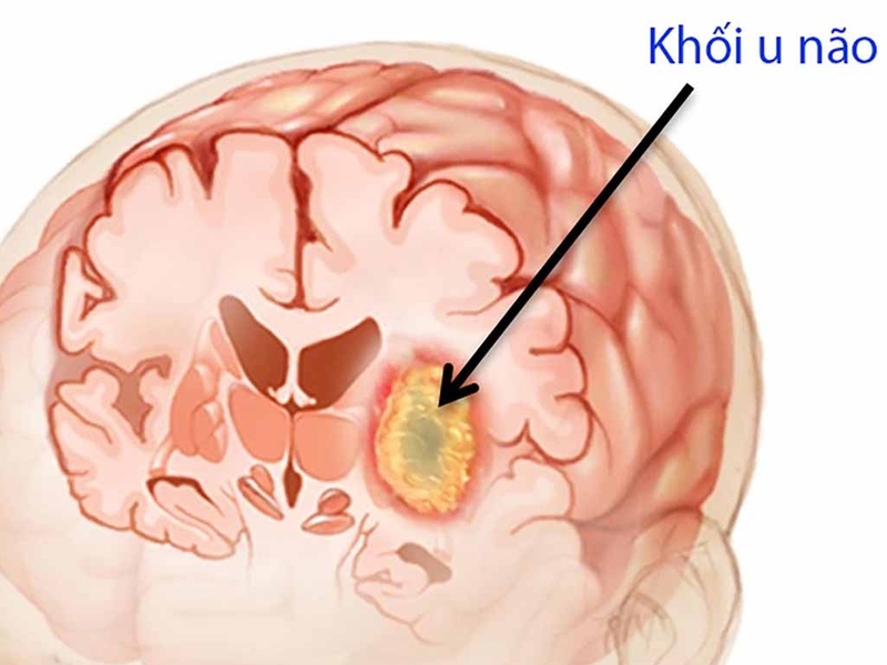 Ù tai mãn tính: Dấu hiệu cảnh báo nguy hiểm 3