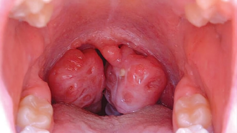 Ù tai ung thư vòm họng là gì? 1