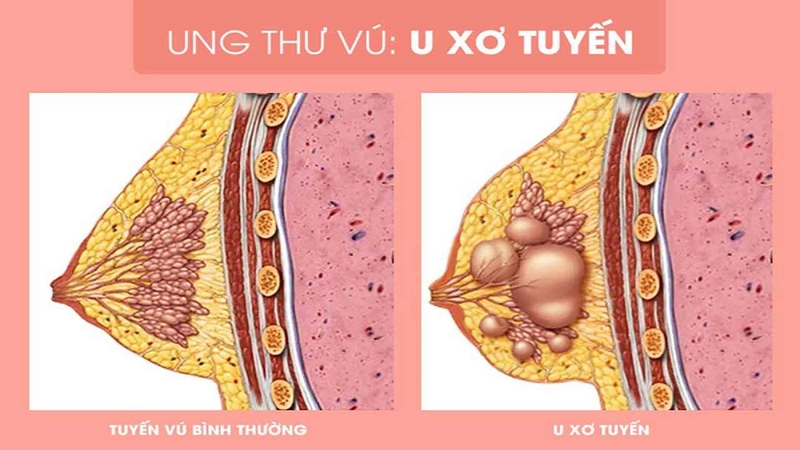 U vú lành tính là gì? Các loại u vú lành tính phổ biến và nguyên nhân hình thành u vú lành tính 3