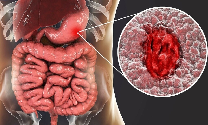 Ung thư dạ dày sống được bao lâu? Tiên lượng từng giai đoạn của ung thư dạ dày 1