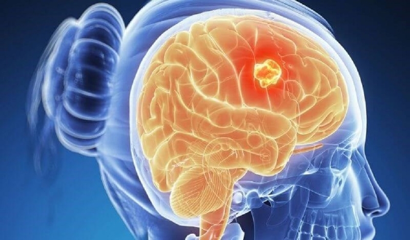 Ung thư não có nên ăn hoa quả không? Ung thư não nên ăn hoa quả gì? 1