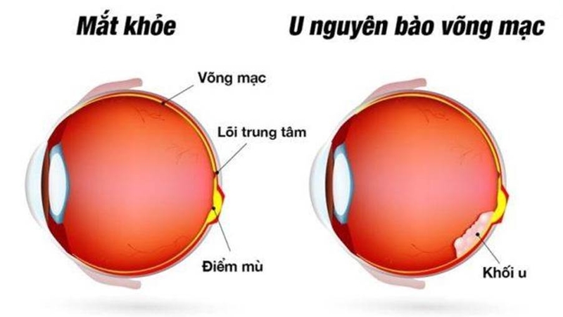 Ung thư nguyên bào võng mạc 1.jpg