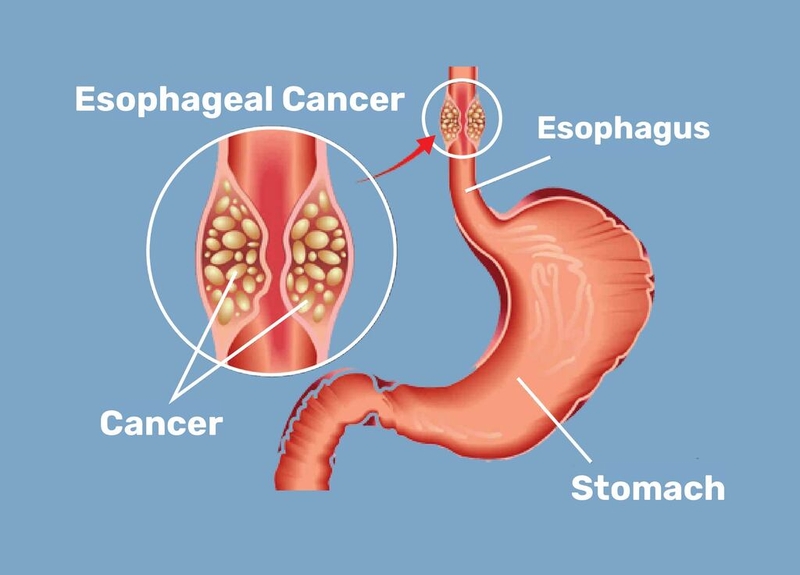 Ung thư thực quản là bệnh gì? Ung thư thực quản có lây không? 4