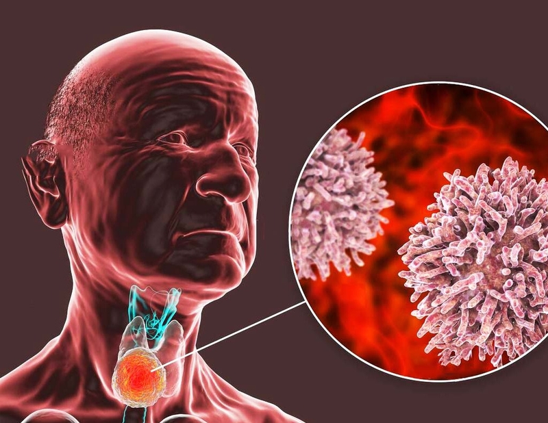 Ung thư tuyến giáp là gì? Dấu hiệu ung thư tuyến giáp giai đoạn cuối 1