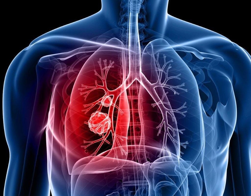 Ung thư vòm họng di căn vào những vùng nào trên cơ thể người? 1