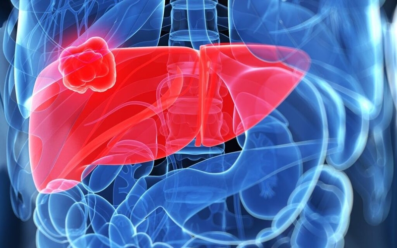 Ung thư vòm họng di căn vào những vùng nào trên cơ thể người? 5