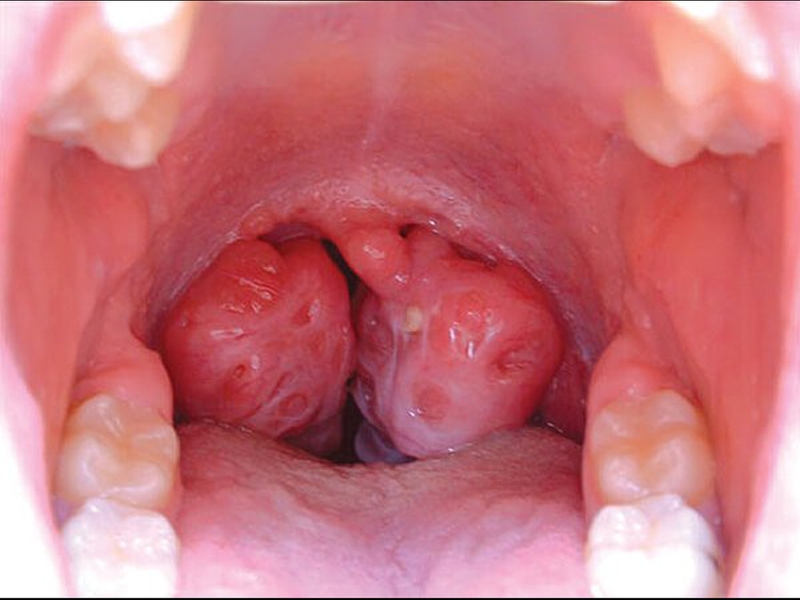 Ung thư vòm họng là gì? Ung thư vòm họng nên ăn gì và kiêng gì? 1