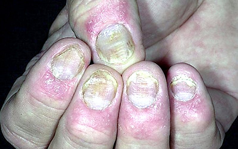 Vảy nến ngón tay có trị được không? 2.png