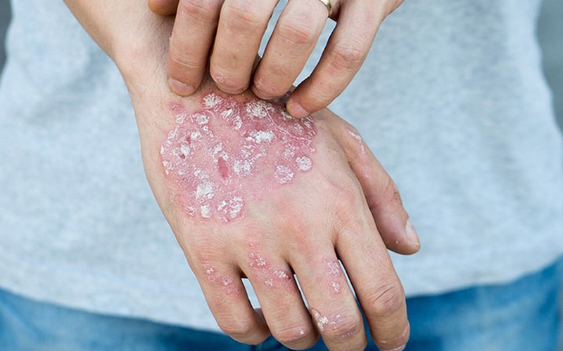 Vảy nến ngón tay có trị được không? 3.png