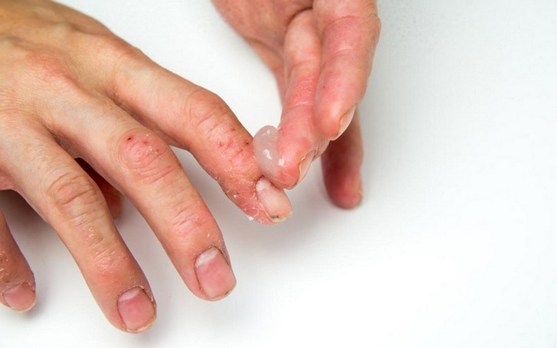 Vảy nến ngón tay có trị được không? 4.png