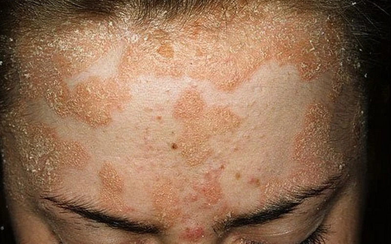 Vảy nến ở mí mắt có sao không? 2.png