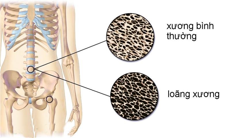 Xẹp đốt sống là gì? Những vấn đề cần biết về xẹp đốt sống 2