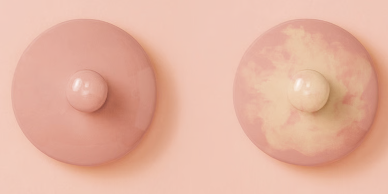 Vì sao ngày càng nhiều phụ nữ mắc ung thư vú 1