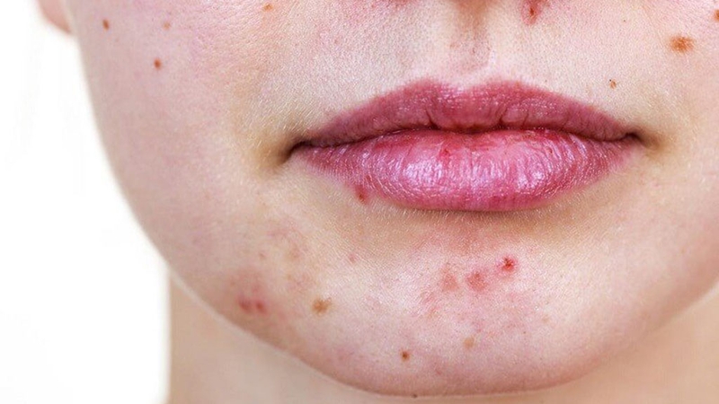Vị trí nổi mụn trên da mặt cảnh báo gì về sức khỏe của bạn 2