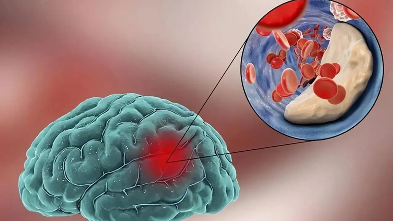 Vị trí xuất huyết não nguy hiểm nhất ở đâu và cách điều trị 3