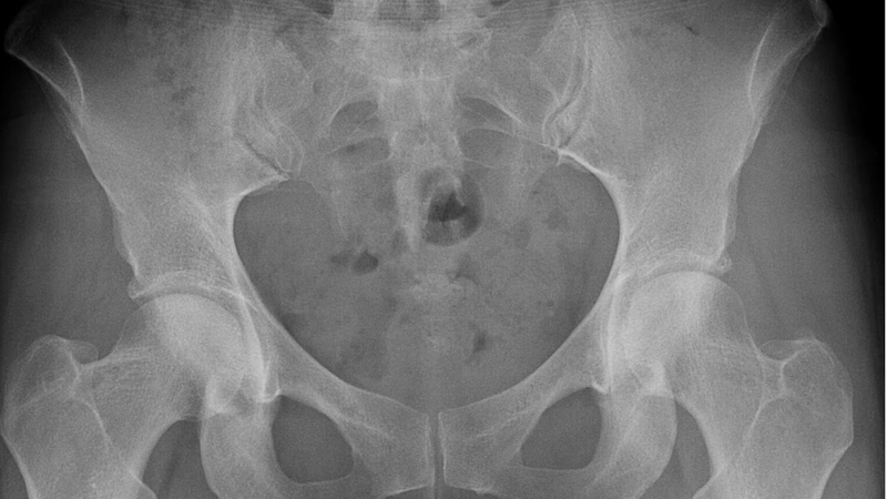 Viêm bao hoạt dịch khớp háng là bệnh gì? Cách điều trị bệnh hiệu quả 4