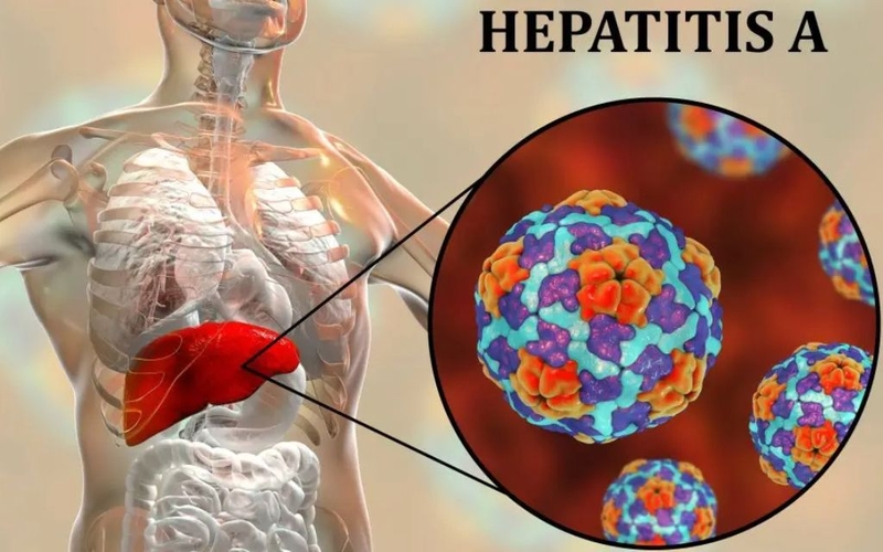 Viêm gan A có chữa được không? Biến chứng và cách phòng ngừa bệnh viêm gan A 2