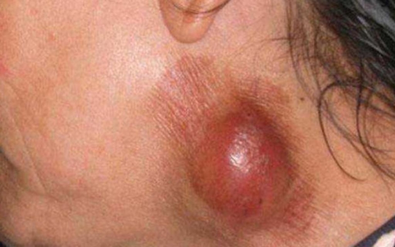 Viêm hạch là gì? Nguyên nhân, triệu chứng và phương pháp điều trị 1