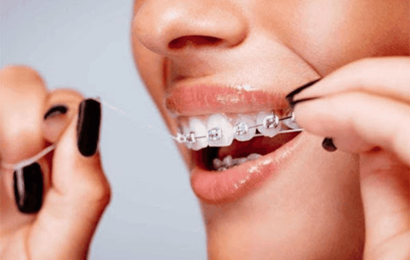 Viêm lợi khi niềng răng và cách điều trị 4.png