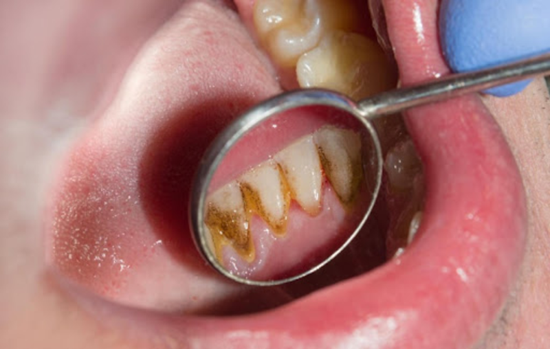 Viêm lợi sưng má là gì 3.png