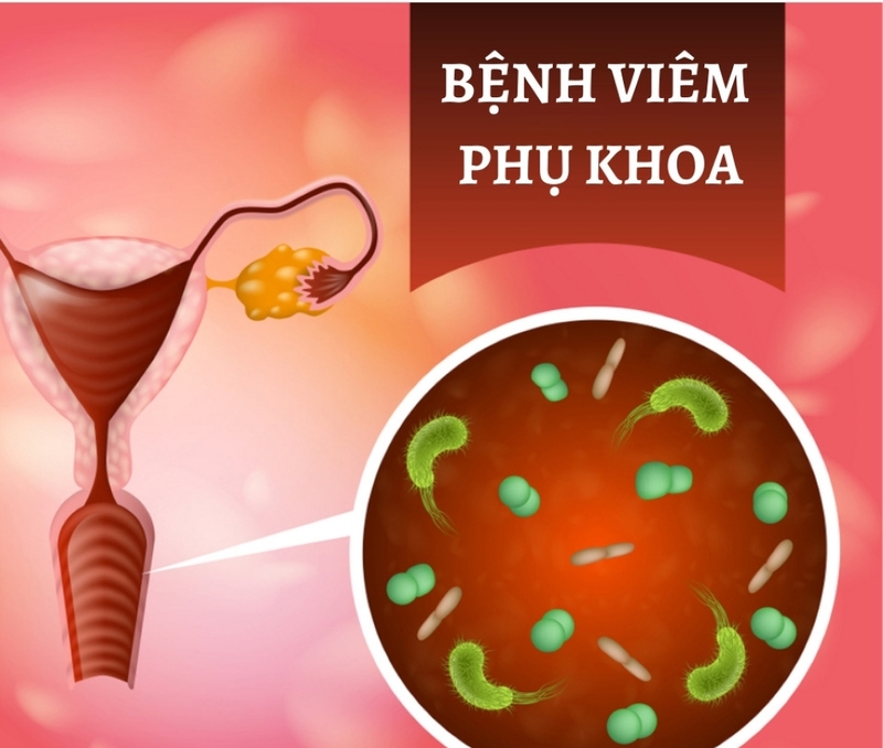 Viêm nhiễm phụ khoa là gì? Làm sao để không bị viêm nhiễm phụ khoa? 1