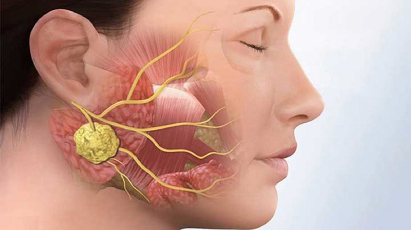 Viêm tuyến nước bọt dưới lưỡi là bệnh gì 2