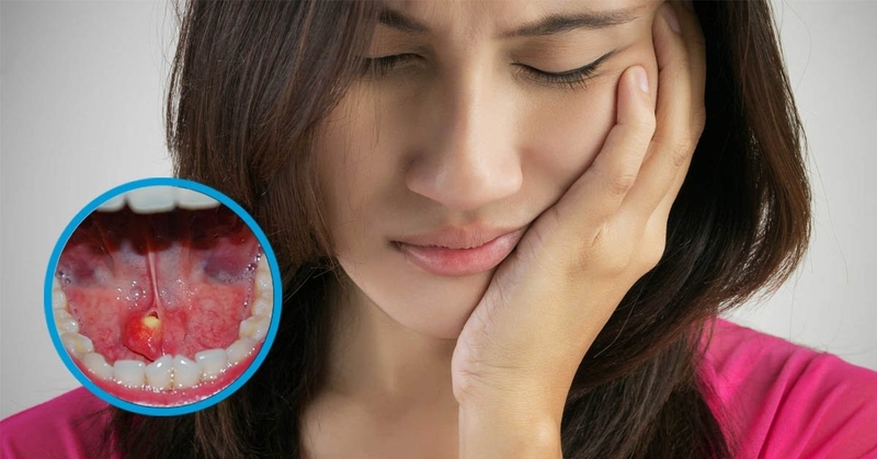 Viêm tuyến nước bọt dưới lưỡi là bệnh gì 3