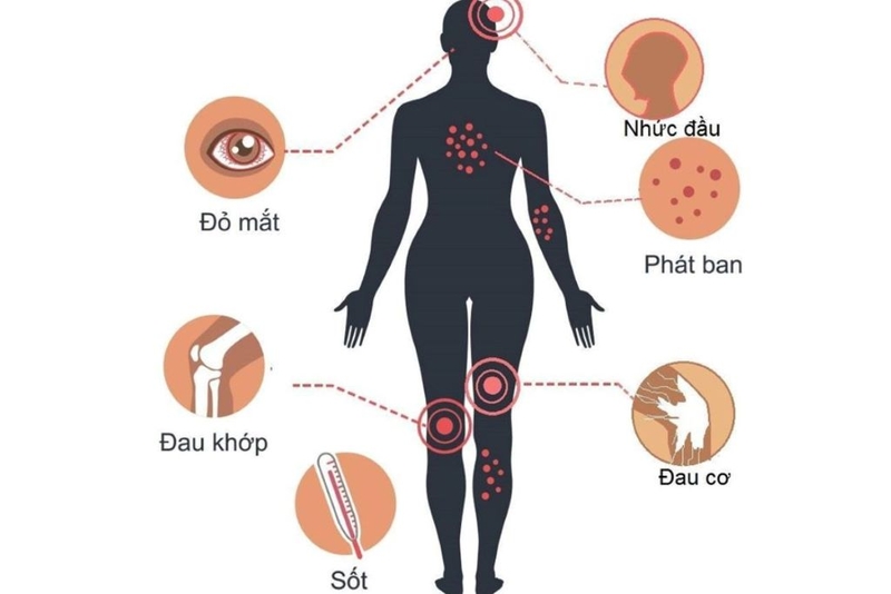 Virus zika gây teo não: Triệu chứng, chẩn đoán và cách điều trị 3