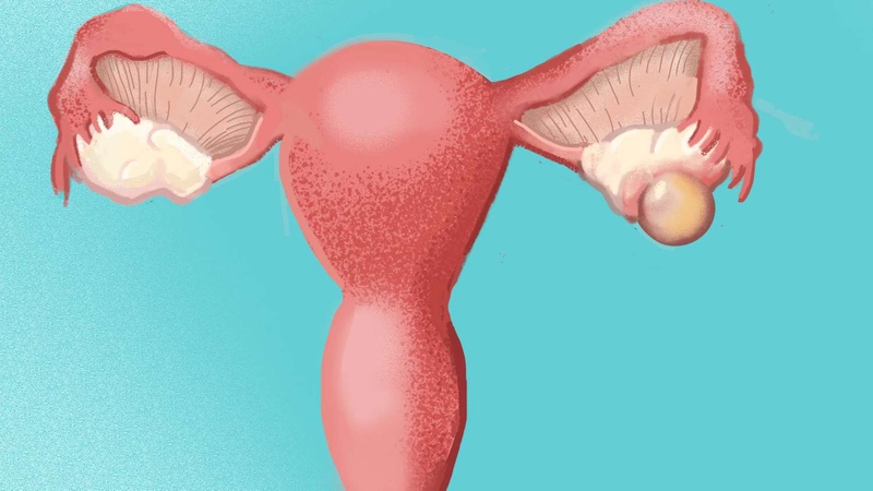 Vỡ nang buồng trứng, những điều cần biết1