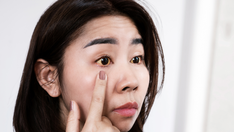 Xơ gan là gì? Dấu hiệu, chẩn đoán và cách điều trị 1