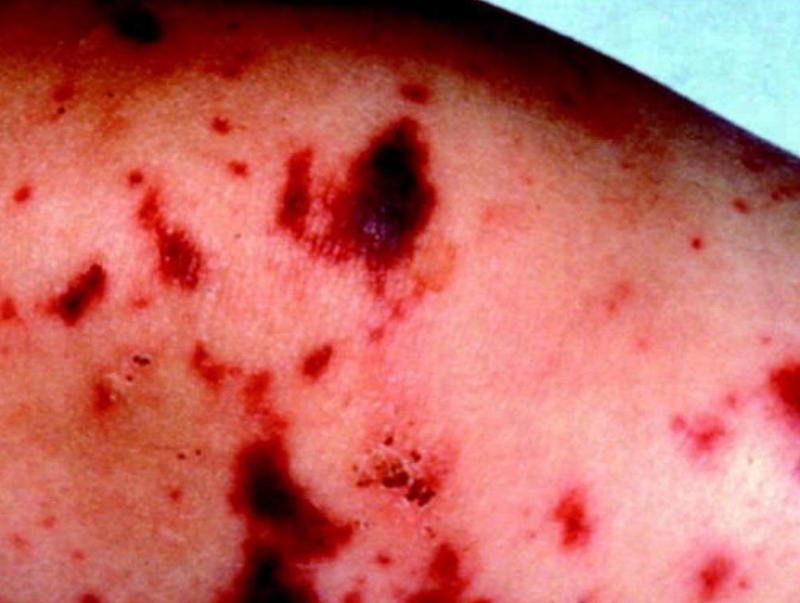 Viêm màng não mô cầu BC tiêm khi nào 1