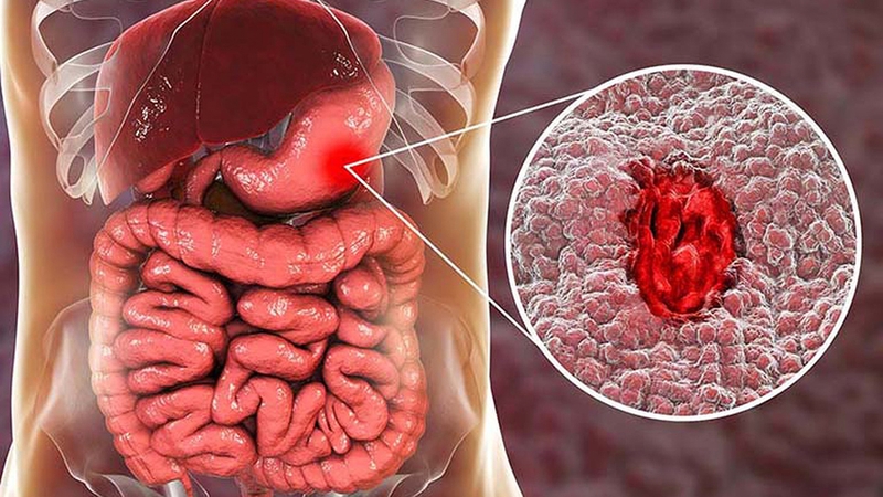 Xuất huyết dạ dày ở người già: Tiềm ẩn nhiều nguy hiểm cho sức khỏe 1