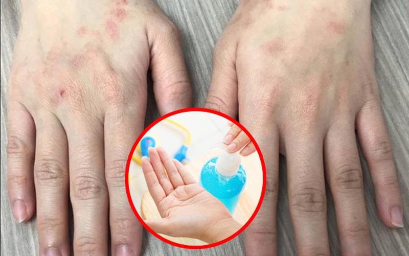 Chú ý không lạm dụng nước rửa tay khô