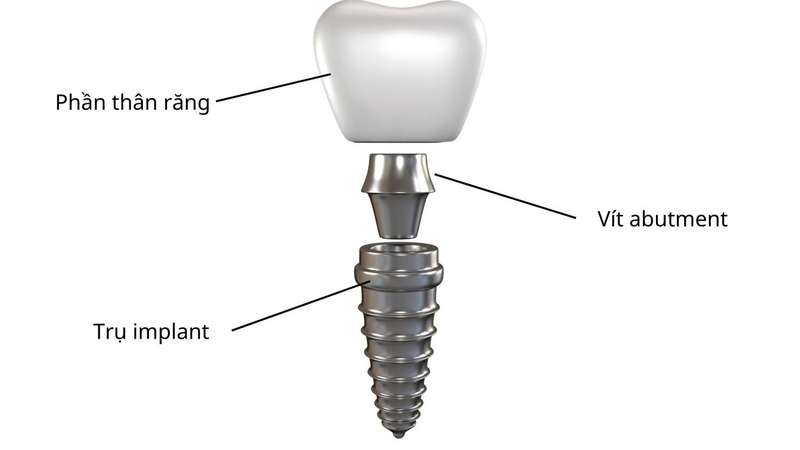 Abutment: Cấu tạo, đặc điểm, phân loại và lưu ý 1