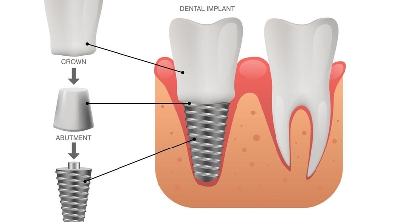Abutment: Cấu tạo, đặc điểm, phân loại và lưu ý 2