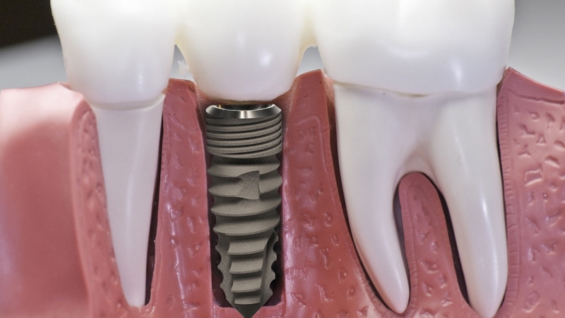 Abutment: Cấu tạo, đặc điểm, phân loại và lưu ý 3
