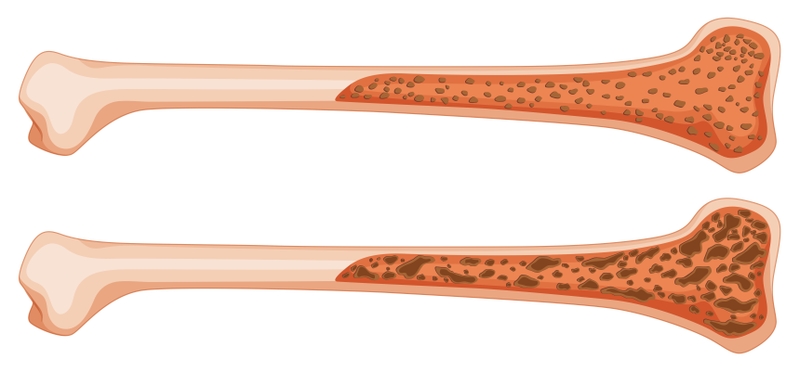 Achondroplasia là bệnh gì? Nguyên nhân gây ra bệnh achondroplasia 2