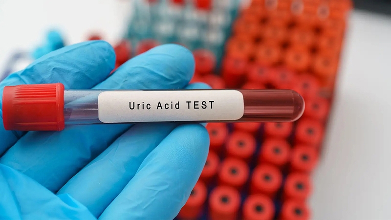 Acid uric 520 là mức cao hay thấp? 1
