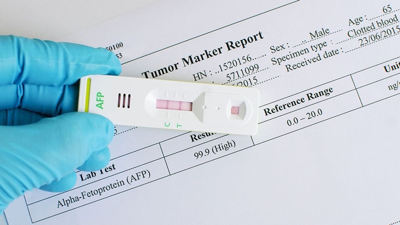 AFP L3 và ý nghĩa của xét nghiệm AFP L3 trong ung thư biểu mô tế bào gan 1