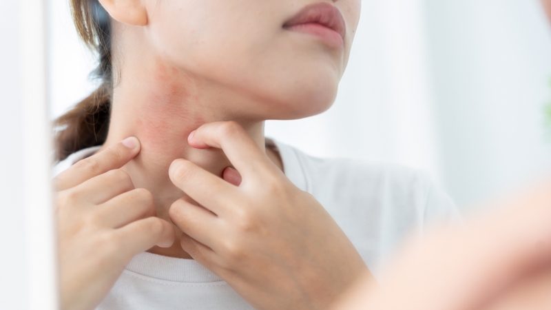 Người dùng có thể xuất hiện các biểu hiện như ngứa da, kích ứng hoặc phát ban