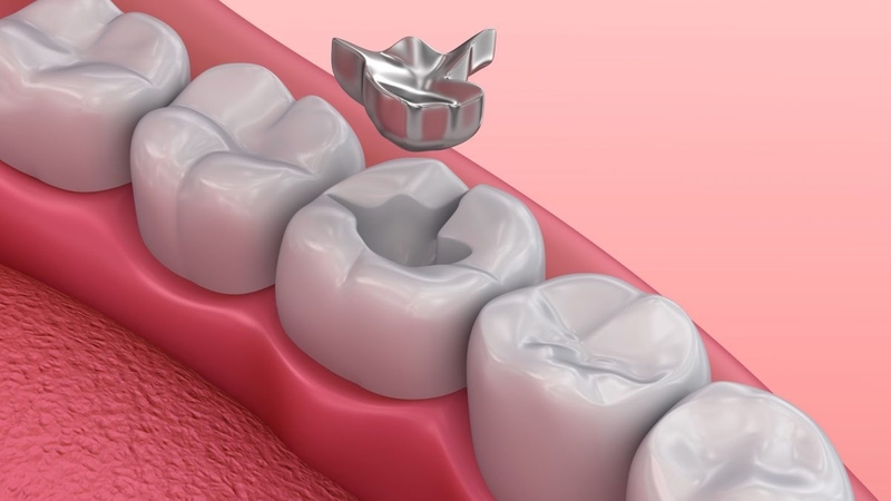 Amalgam là gì? Một số thông tin bạn cần biết về vật liệu trám răng Amalgam 1