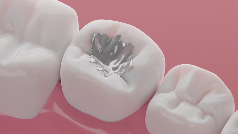 Amalgam là gì? Một số thông tin bạn cần biết về vật liệu trám răng Amalgam 4