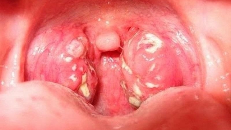 Amidan có đốm trắng – Những điều cần biết 1