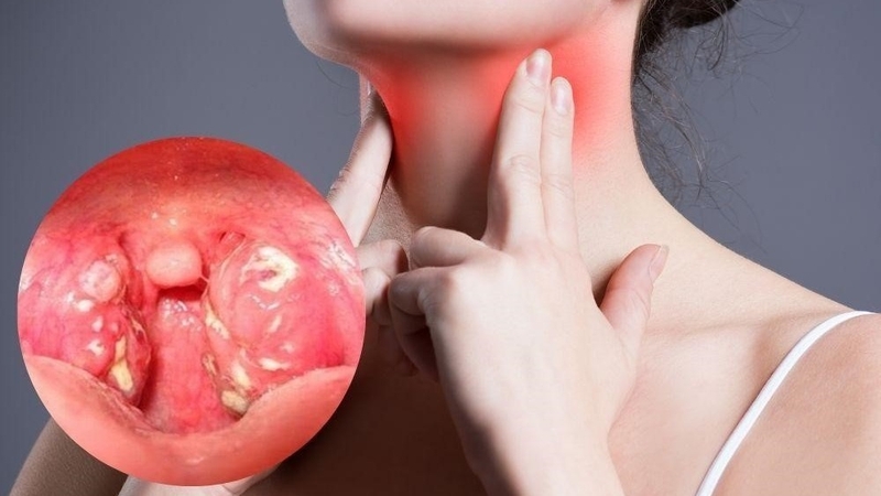 Amidan có đốm trắng – Những điều cần biết 2