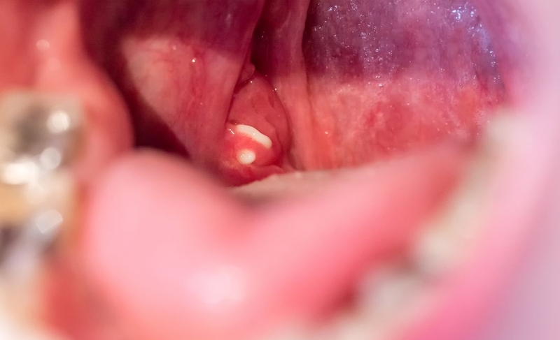 Amidan có tác dụng gì? Các vấn đề thường gặp với amidan 2