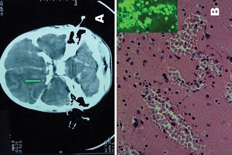 Amip ăn não: Nhận biết nguyên nhân, triệu chứng, điều trị và cách phòng ngừa 2