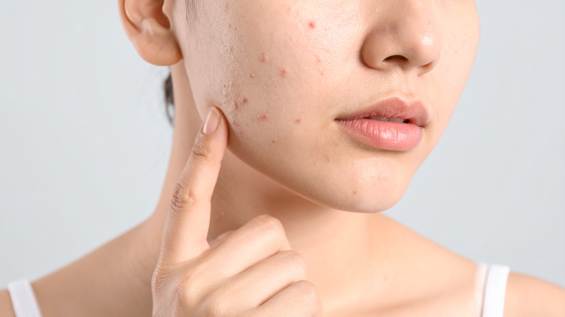 Ăn các thực phẩm chứa nhiều muối trong thời gian dài có thể khiến làn da kém khỏe mạnh